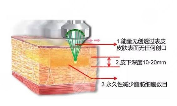 超脂塑溶脂是采用的什么技术