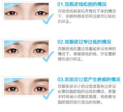 上海双眼皮修复厉害医生名单