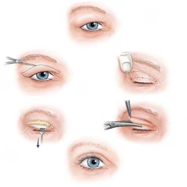 青岛刘学源双眼皮修复多少钱