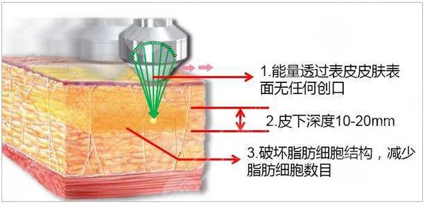 超脂塑溶脂是什么