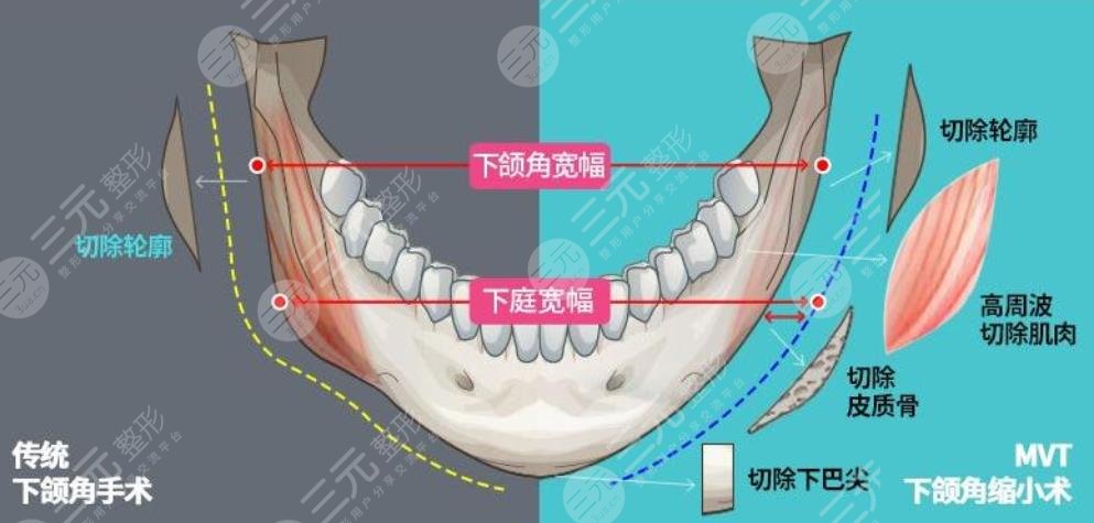 广州下颌角手术医生排名