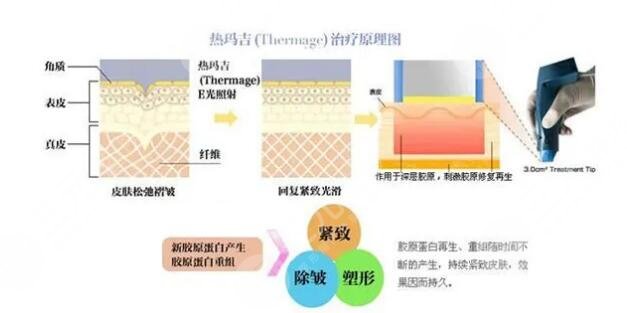 做完熱瑪吉后臉垮了