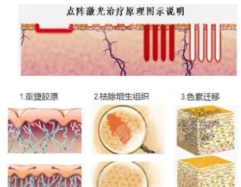 杭州全脸激光多少钱