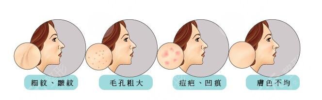 飛梭鐳射去痘坑需要幾次