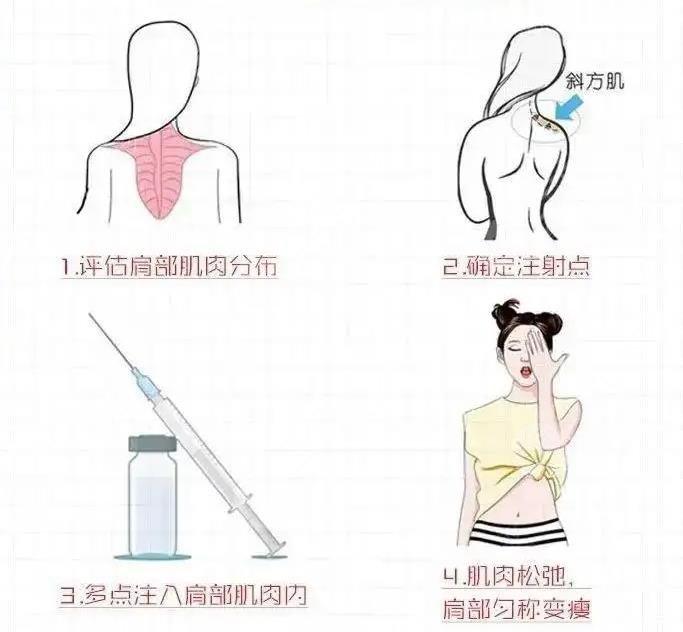 瘦肩針有什么危害和副作用