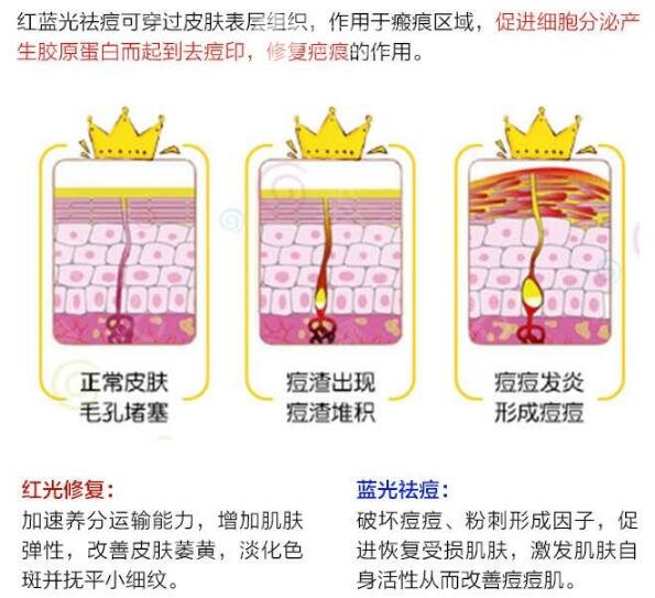 深圳港大医院激光祛痘费用公布