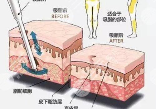 抽脂肪對(duì)身體有什么副作用