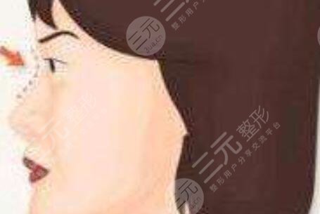 上海清杨整形美容医院价格表附隆鼻+自体脂肪丰额头真人案例果