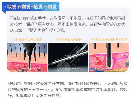 广州哪家植发技术好