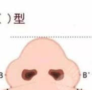 成都華西醫(yī)院整形科卿勇專家鼻畸形矯正做的咋樣 附案例