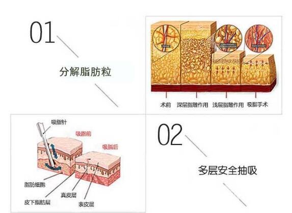 胳膊吸脂大概花多少錢