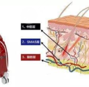 上海九院董繼英熱拉提果怎么樣