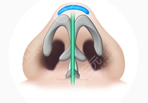 耳软骨隆鼻的恢复期是多久