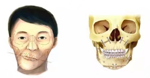 薛国初正颌手术怎么样