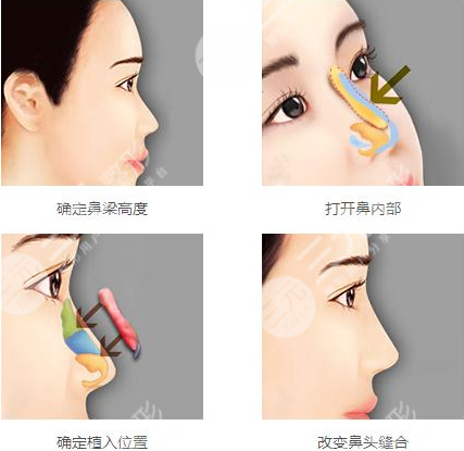 成都周顺波做鼻子咋样