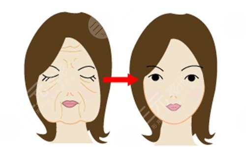 面部拉皮手術(shù)提升效果和視頻賞析