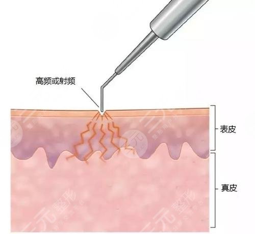 中山大學(xué)附屬第一醫(yī)院美容祛痣專家一覽