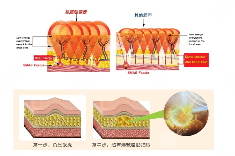 超脂塑溶脂比傳統(tǒng)吸脂手術(shù)的優(yōu)勢(shì)在哪里