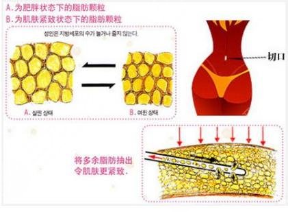 背部吸脂瘦身术成好吗