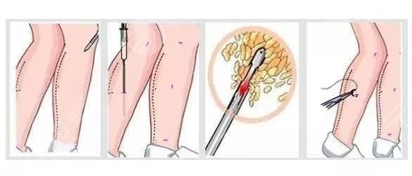 吸脂瘦腿的方法有幾種