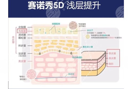 賽諾秀5D和超聲泡哪個好