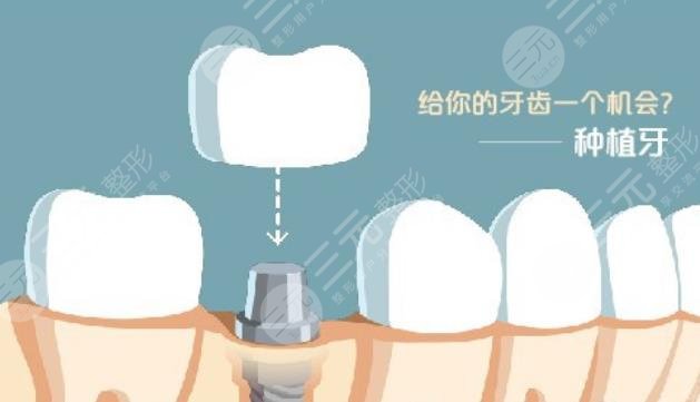 2022上海种植牙医院排行更新