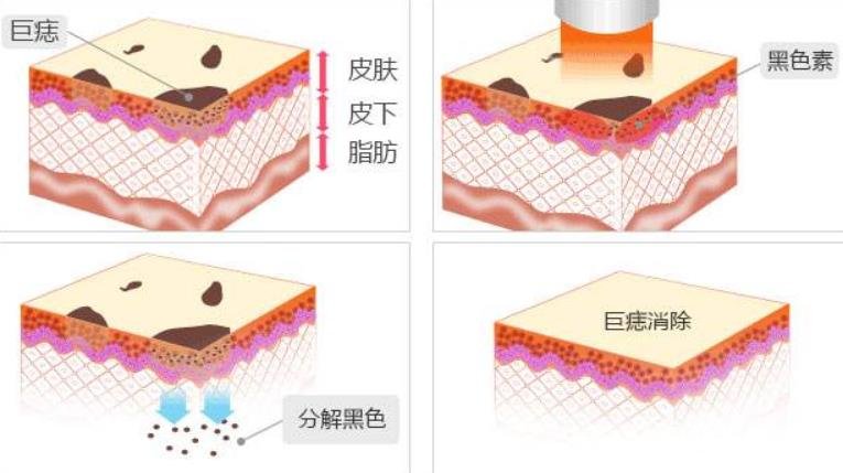 南昌一附院美容科点痣技术好不好