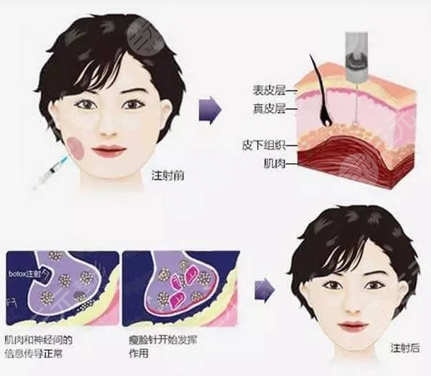 注射瘦脸多久打一次