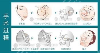 王杭醫(yī)生做下巴怎么樣