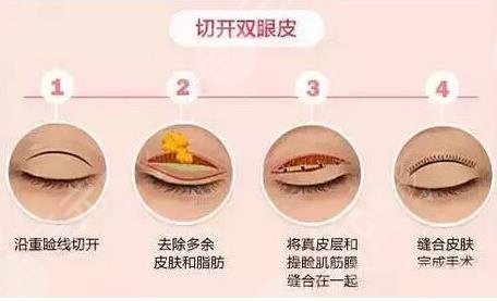 天津修复双眼皮专家排名