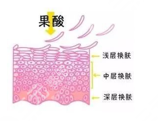 果酸換膚的功效是什么