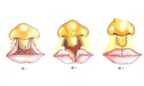 兔唇是什么原因造成的