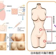 上海時光整形醫(yī)院自身脂肪豐胸怎么樣