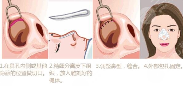 上海邱文苑做鼻子怎么樣