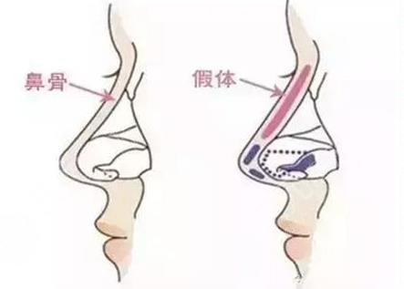 深圳鼻王是谁