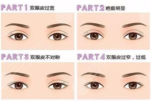 上海双眼皮修复专家排名