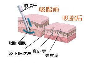 程紅濤吸脂怎么樣