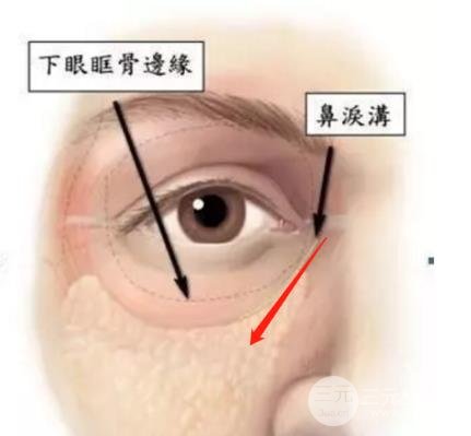 黃多多長大后淚溝黑眼圈全消