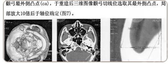 于國東降顴骨怎么樣