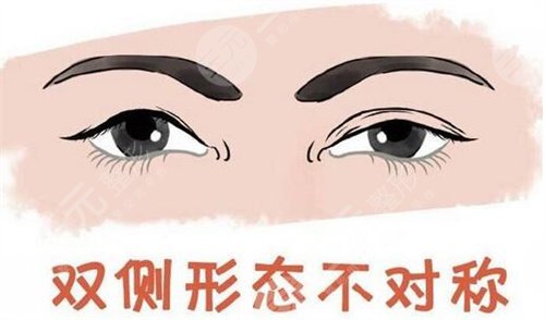 广州双眼皮修复哪个医生比较好