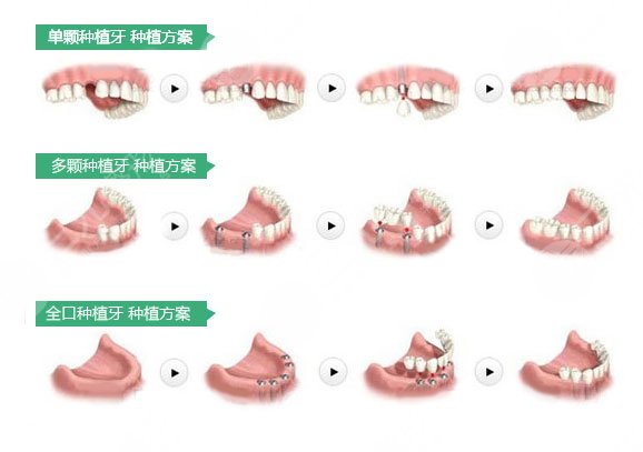 上海哪家口腔医院种植牙好