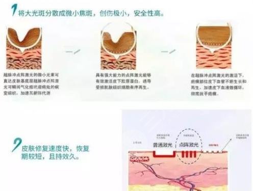 王連召疤痕切除手術(shù)費