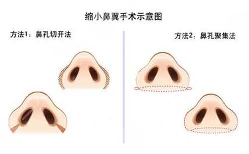 上海程旭医生做鼻子怎么样