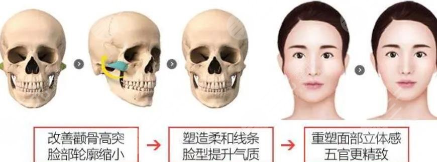 北京八大处杨斌颧骨下颌角手术案例有吗