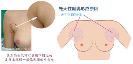 杭州副乳切除手术喜欢的医院