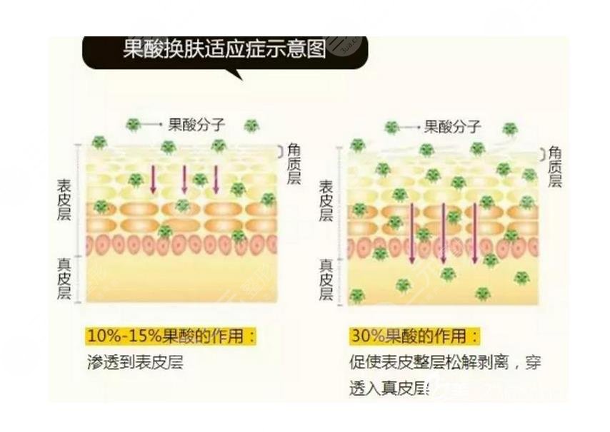 果酸換膚祛痘管用嗎