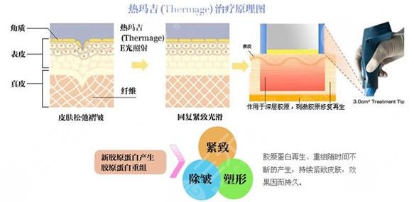 重庆美莱张东梅热玛吉如何