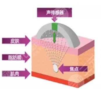 超脂塑溶脂手术适应症有哪些