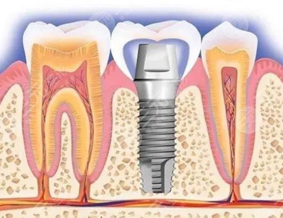 广州哪个医院种植牙便宜又好