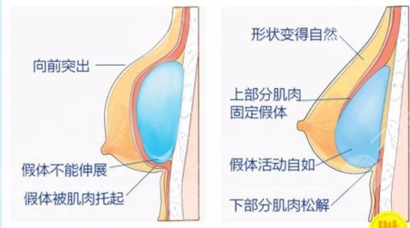 水晶藍貝假體是國產嗎